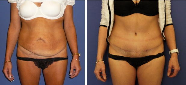 abdominoplastie douleur cicatrice abdominoplastie douleur cicatrice