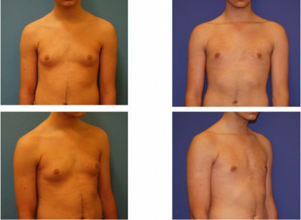 gynecomastie